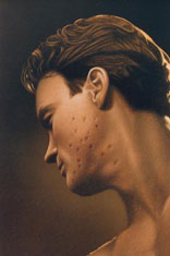 dermabrasion-1