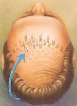 hair_replacement-2