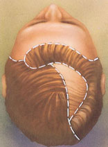 hair_replacement-4