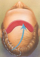 hair_replacement-5