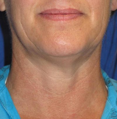 VelaShape