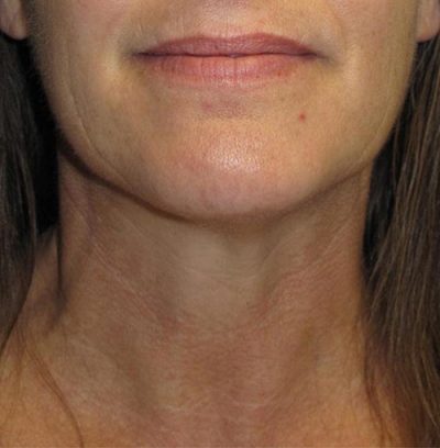 VelaShape