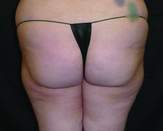 VelaShape