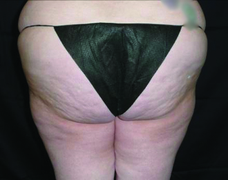 VelaShape